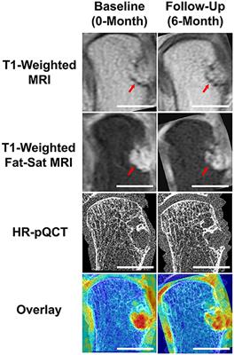 Multi-Modal Imaging to Assess the Interaction Between Inflammation and Bone Damage Progression in Inflammatory Arthritis